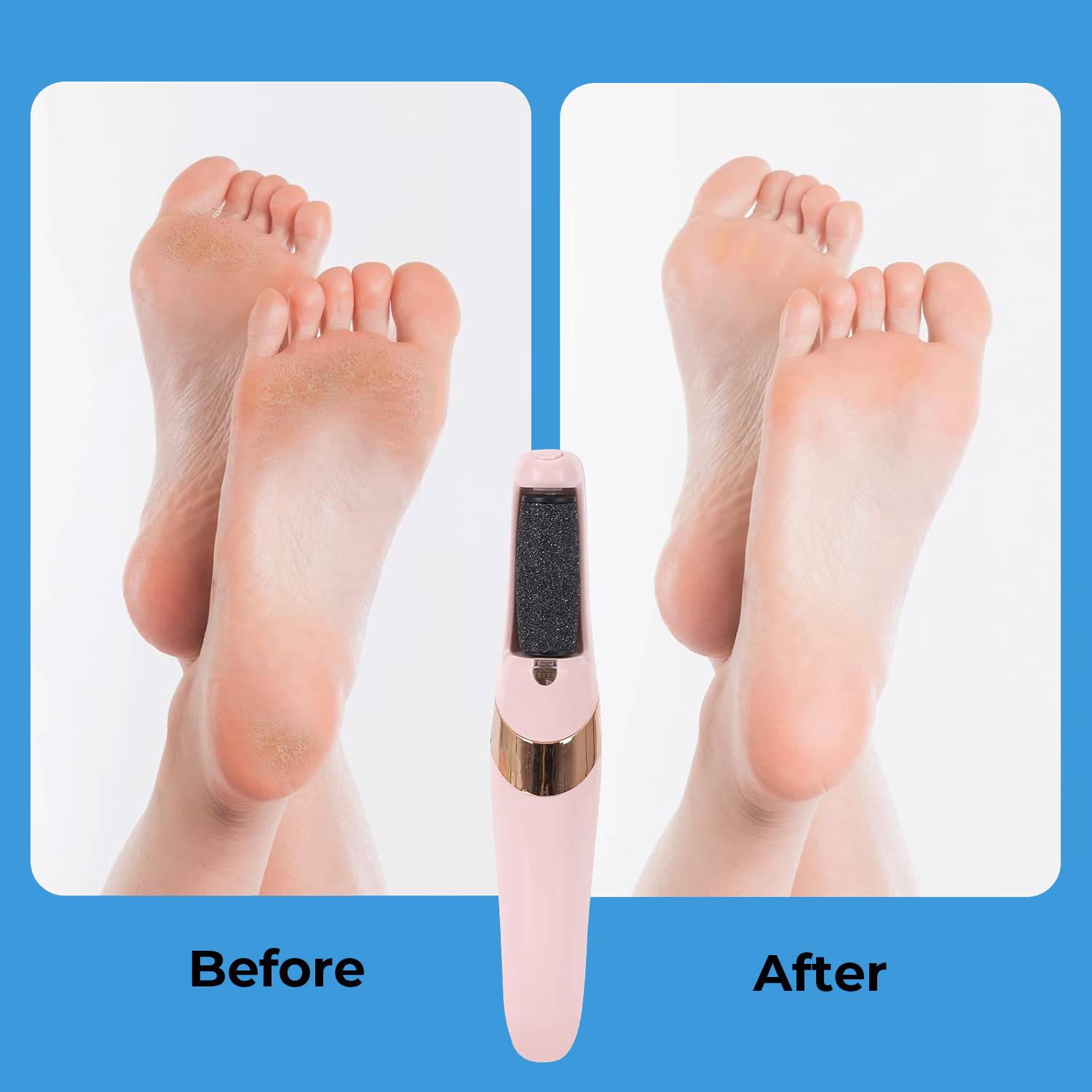 Foot Callus Remover